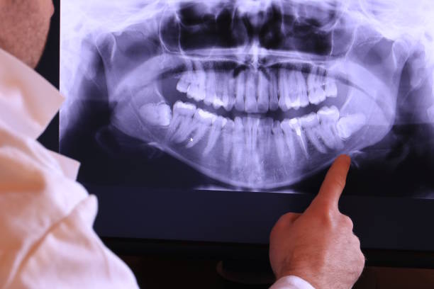Best Knocked-Out Tooth (Avulsed Tooth) Treatment in Rocky Point, NY